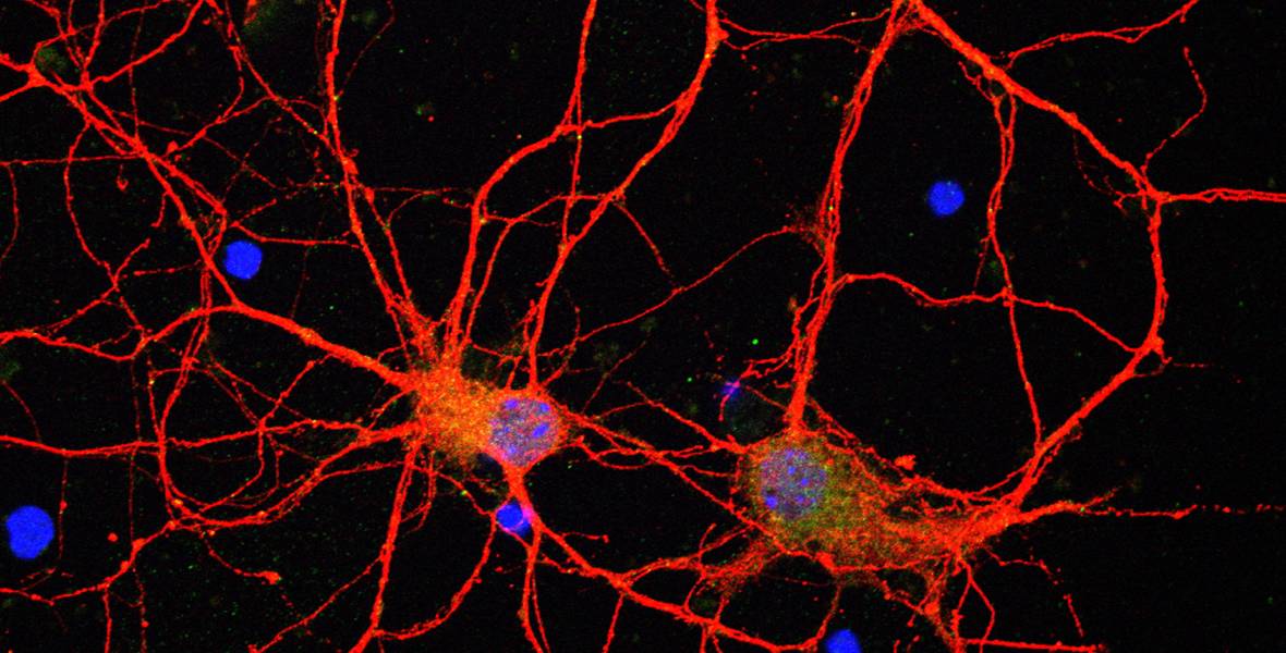 Identificados tres genes presentes en la parálisis supranuclear progresiva Investigadores del CIMA y la Clínica Universidad de Navarra participan en un estudio internacional que abre nuevas vías para el tratamiento de ésta y otras enfermedades neurodegenerativas, como el Alzheimer