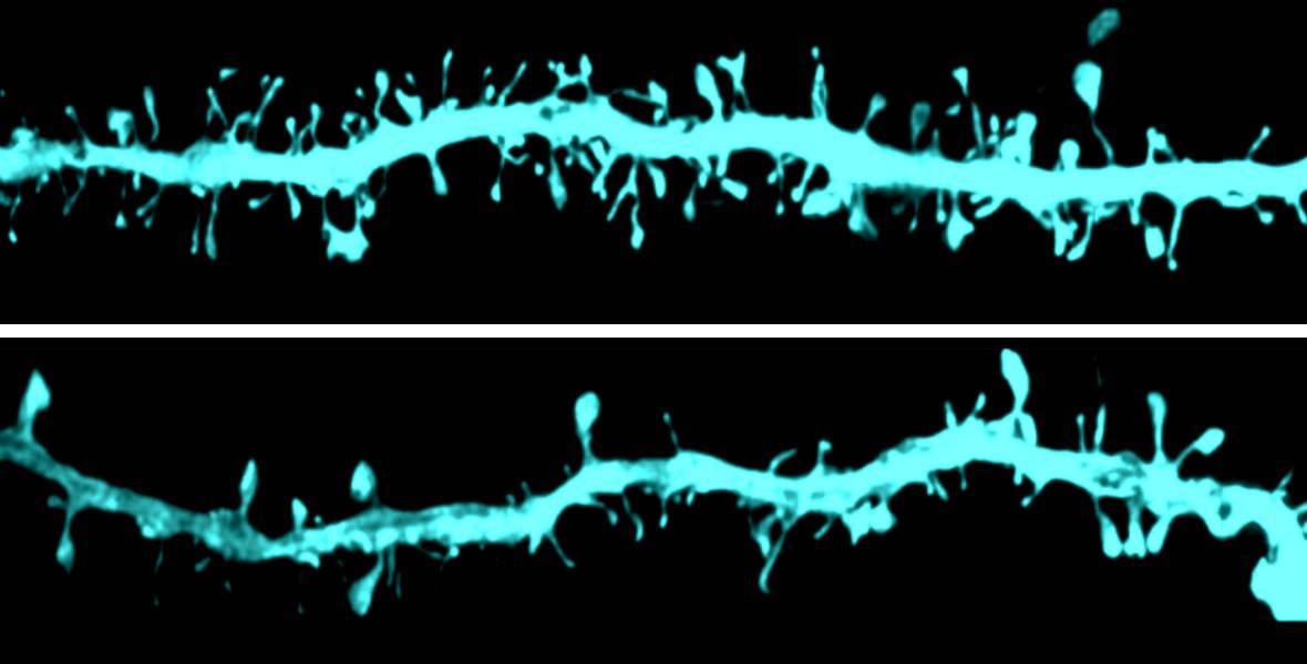 Imagen cerebros con Parkinson presentan cambios funcionales antes de desarrollar degeneración neuronal y síntomas de la enfermedad