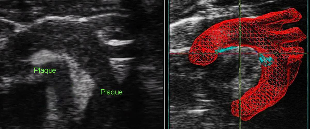 placas-ateroma-vevo-3100