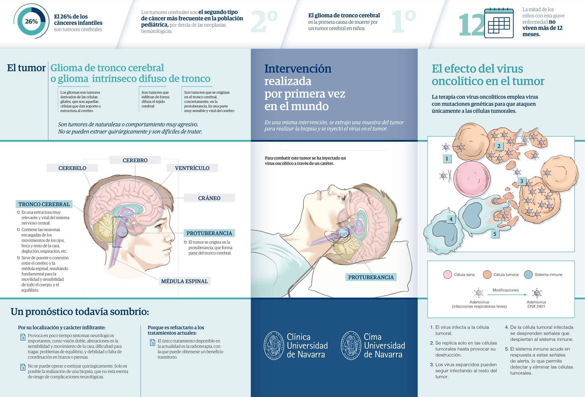 Infografía. Virus oncolíticos para tumor cerebral en niños